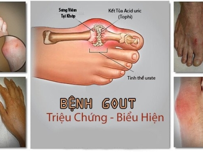 Bệnh gout: Nguyên nhân, biểu hiện và cách điều trị