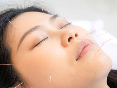 Châm cứu trong điều trị liệt dây thần kinh số 7 như thế nào ?