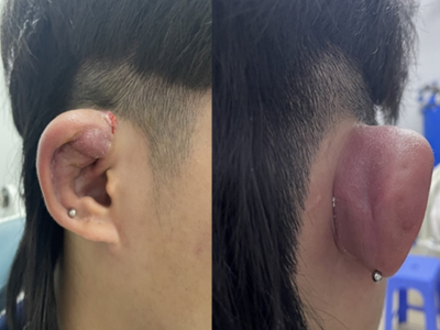 Dấu hiệu xỏ khuyên tai bị nhiễm trùng và cách xử lý