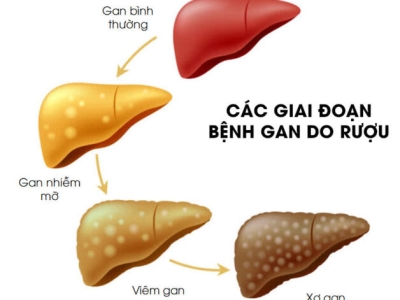 Rượu bia có hại cho gan như thế nào?